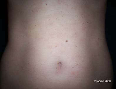 pytiriasis